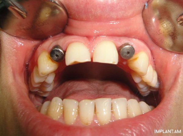 По одному имплантату в области 12 и 22 зубов